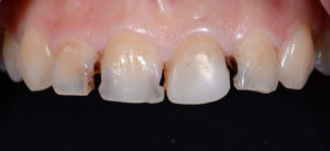 4 Decayed teeth