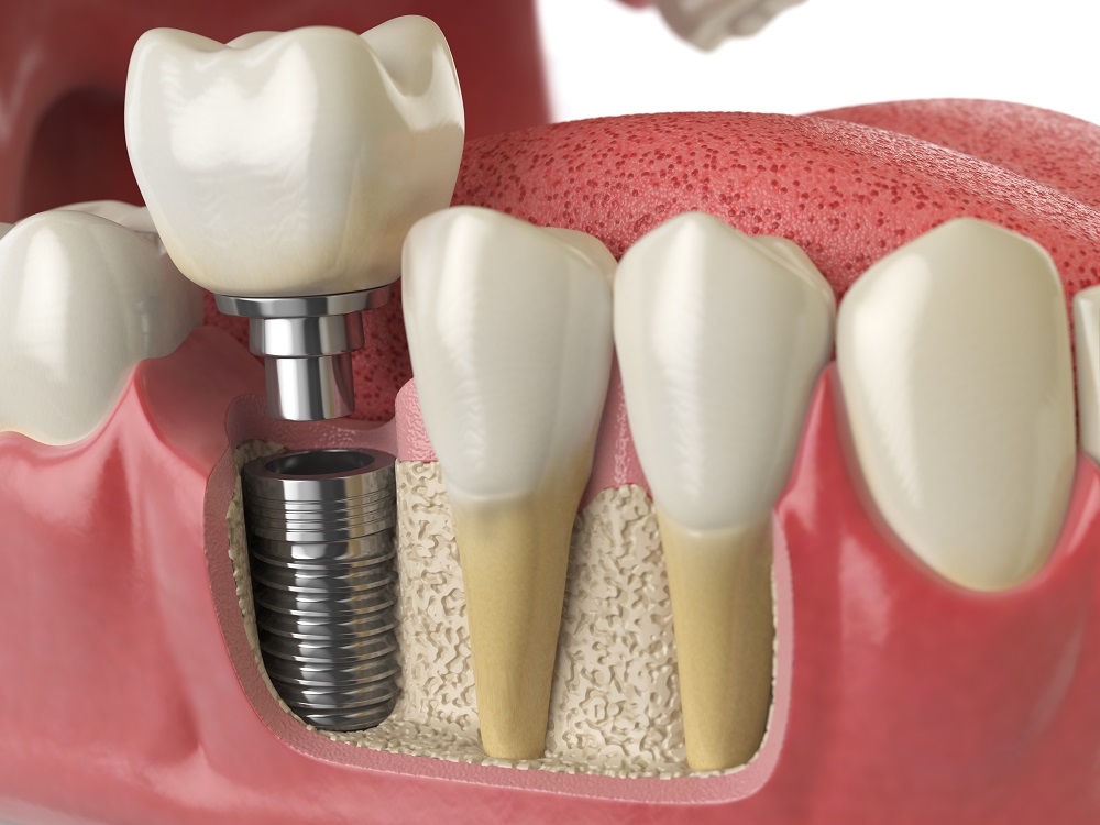 A model of an implanted tooth