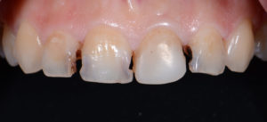 Ästhetische Veneers 4 Decayed teeth