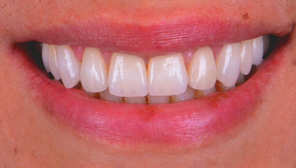 Zahnkrone und Zahnbrücke (Beispiel einer Behandlung von Zahnarzt Wien Dr. Azzawi)