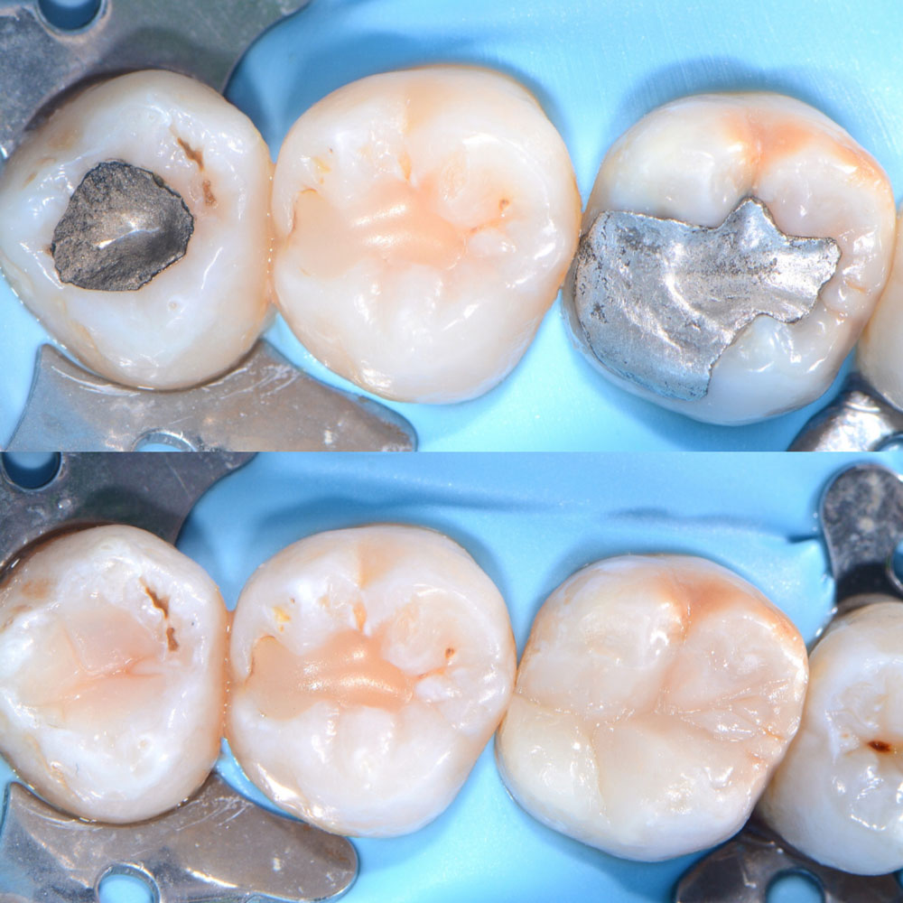 Amalgamsanierung-vorher-nachher