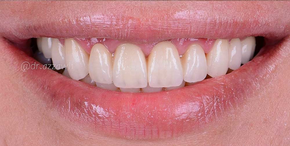 Zahnfleischkorrektur .gummy smile Behandlung