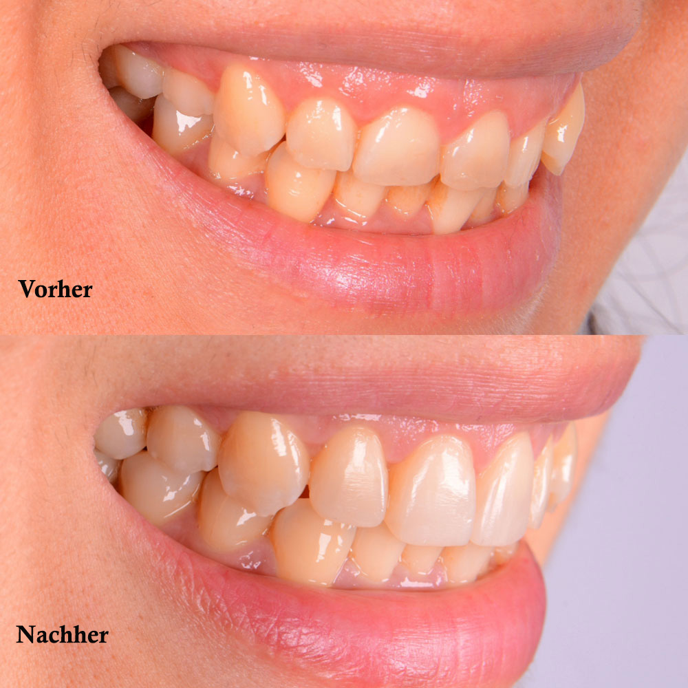 gummy smile vorher nachher-2 / Zahnfleischkorrektur vorher nachher in Wien / Dr. Azzawi