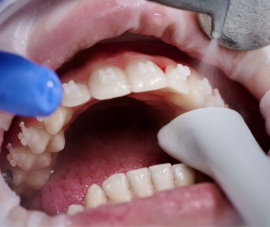 Professionelle Mundhygiene für Parodontitis