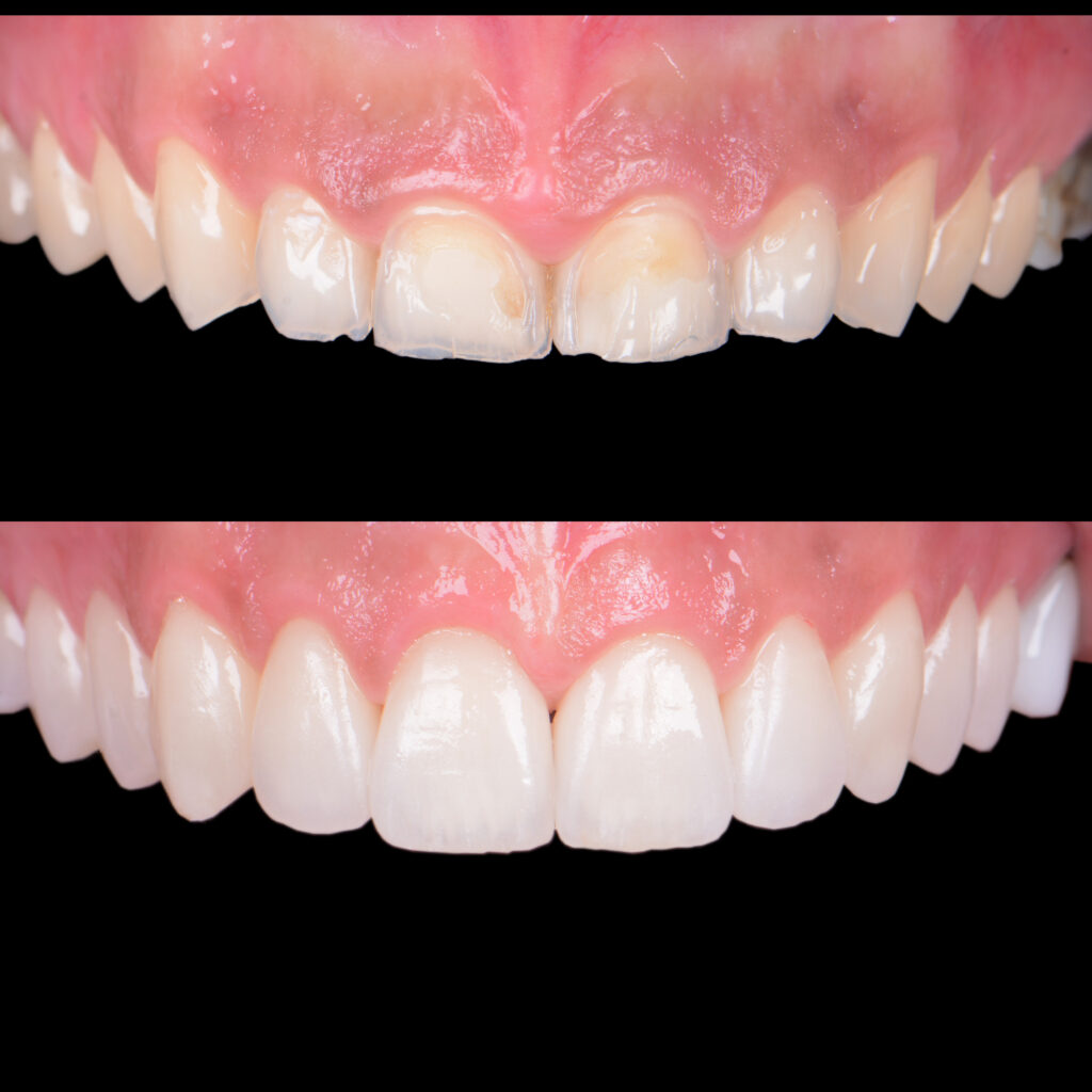 Veneers before and after vienna