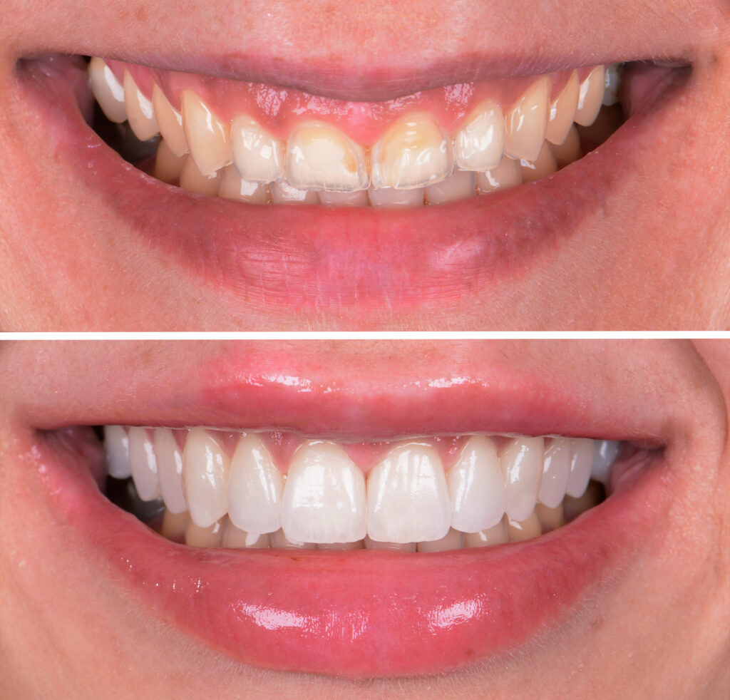 Veneers vorher nachher 1010 wien