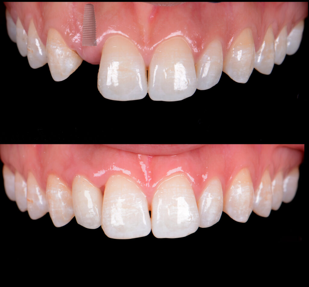 Zahnimplantate vorher nachher
