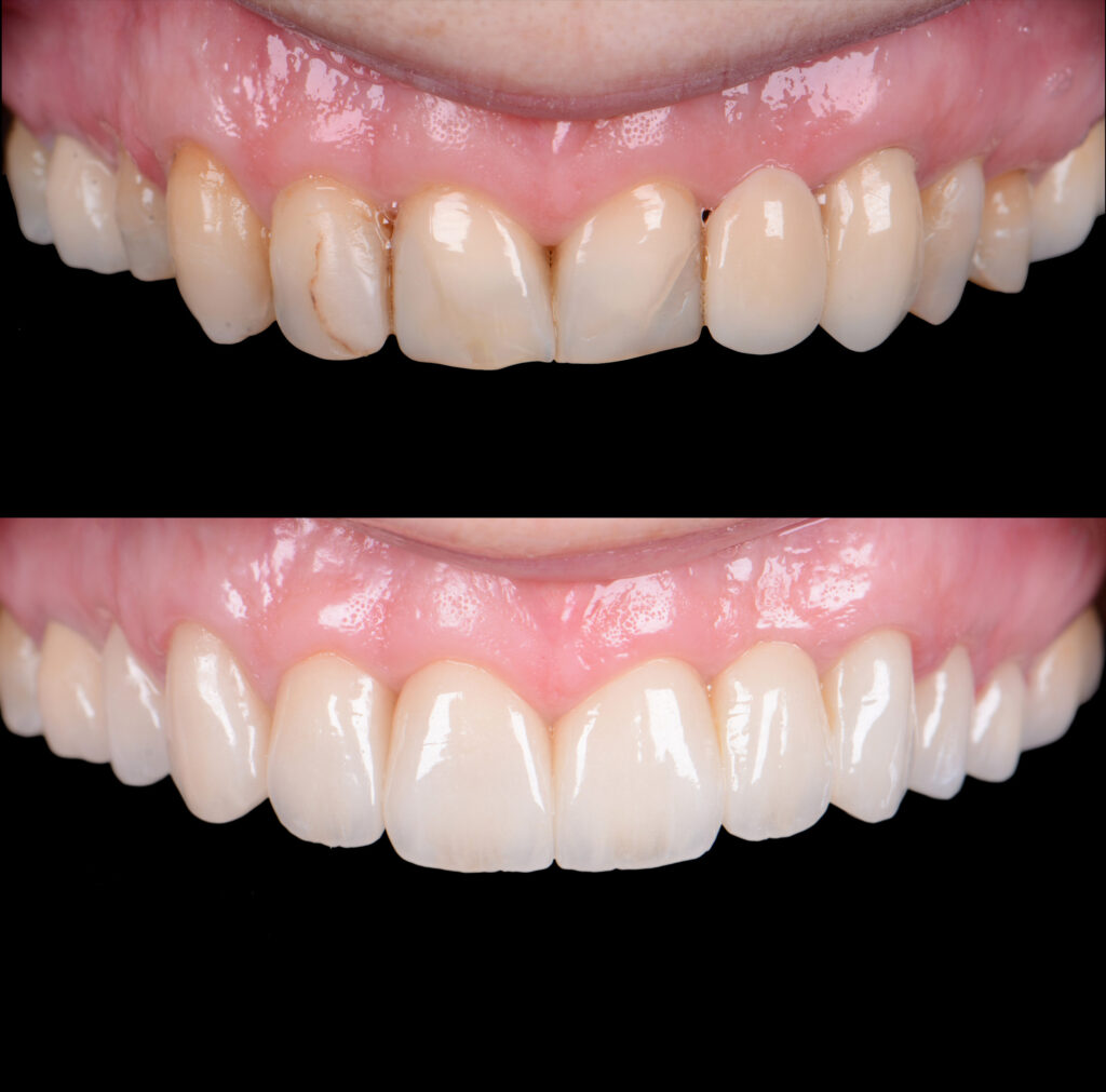 Zahnkrone vorher nachher