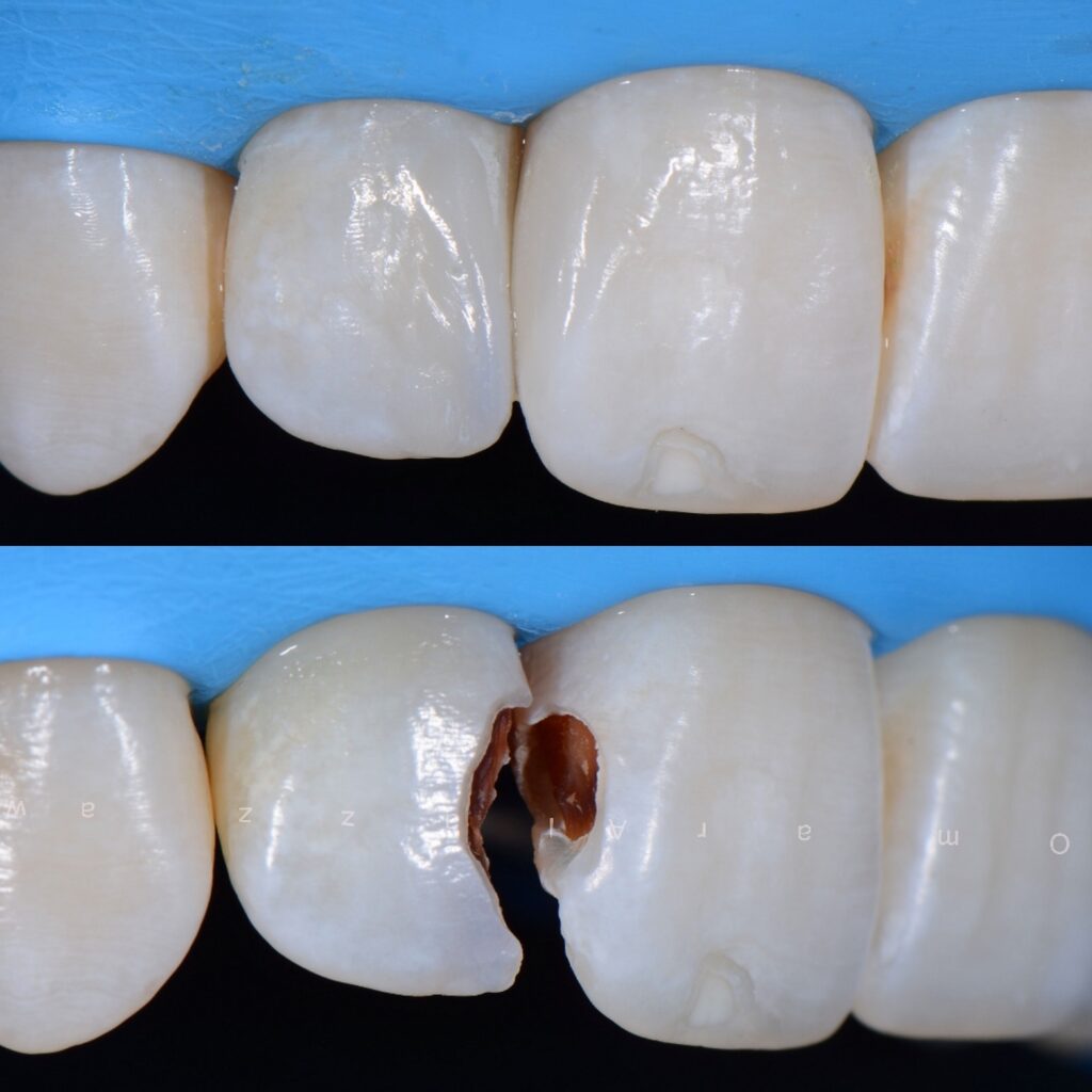 frontzahnfüllung vorher nachher
