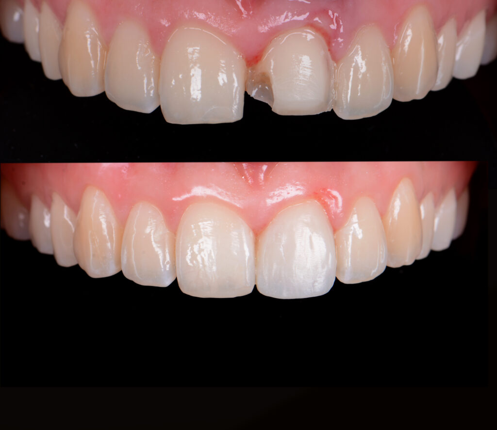 rontzahnfüllung vorher nachher