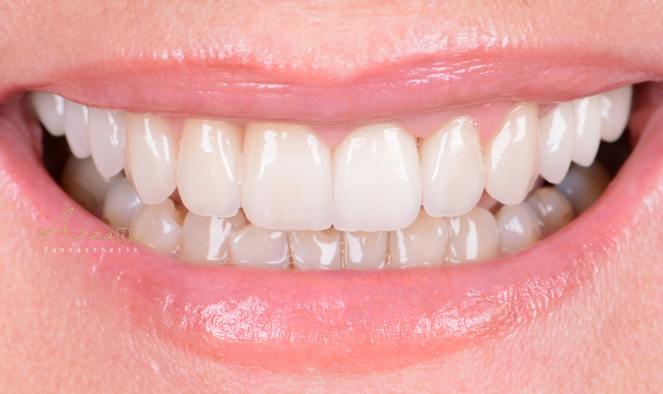 vollkeramik zahnkrone