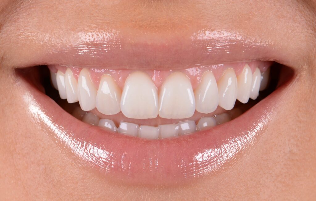 Gummy Smile / veneers