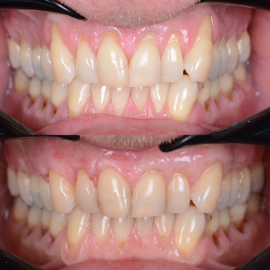 zahnfleischrückgang