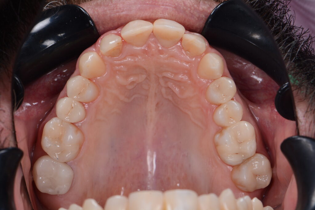 Keramik / kompositfüllung