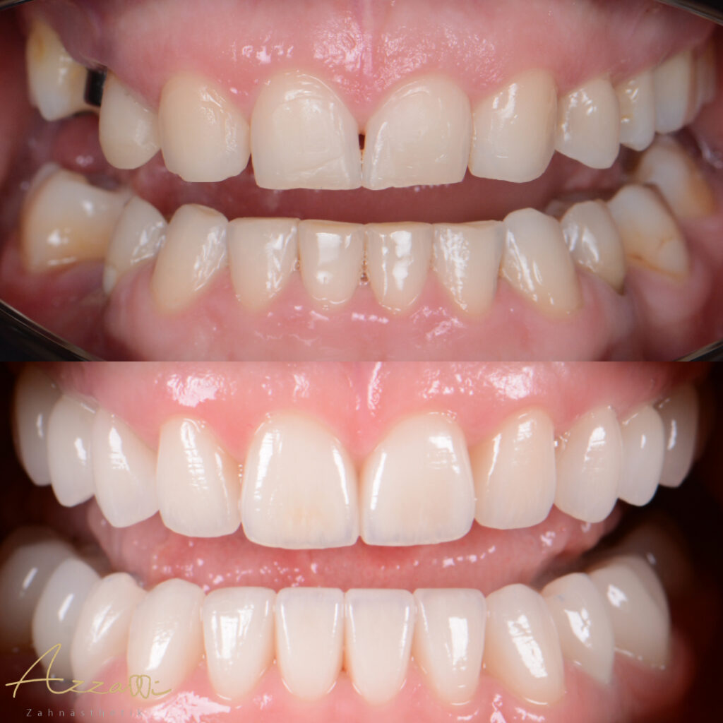 veneers Zahnreinigung